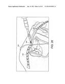 ACROMIOCLAVICULAR JOINT FIXATION USING SUTURE BUTTON CONTSTRUCT WITH DOG     BONE-SHAPED BUTTON diagram and image