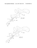 INFLATABLE, STEERABLE BALLOON FOR ELEVATION OF TISSUE WITHIN A BODY diagram and image