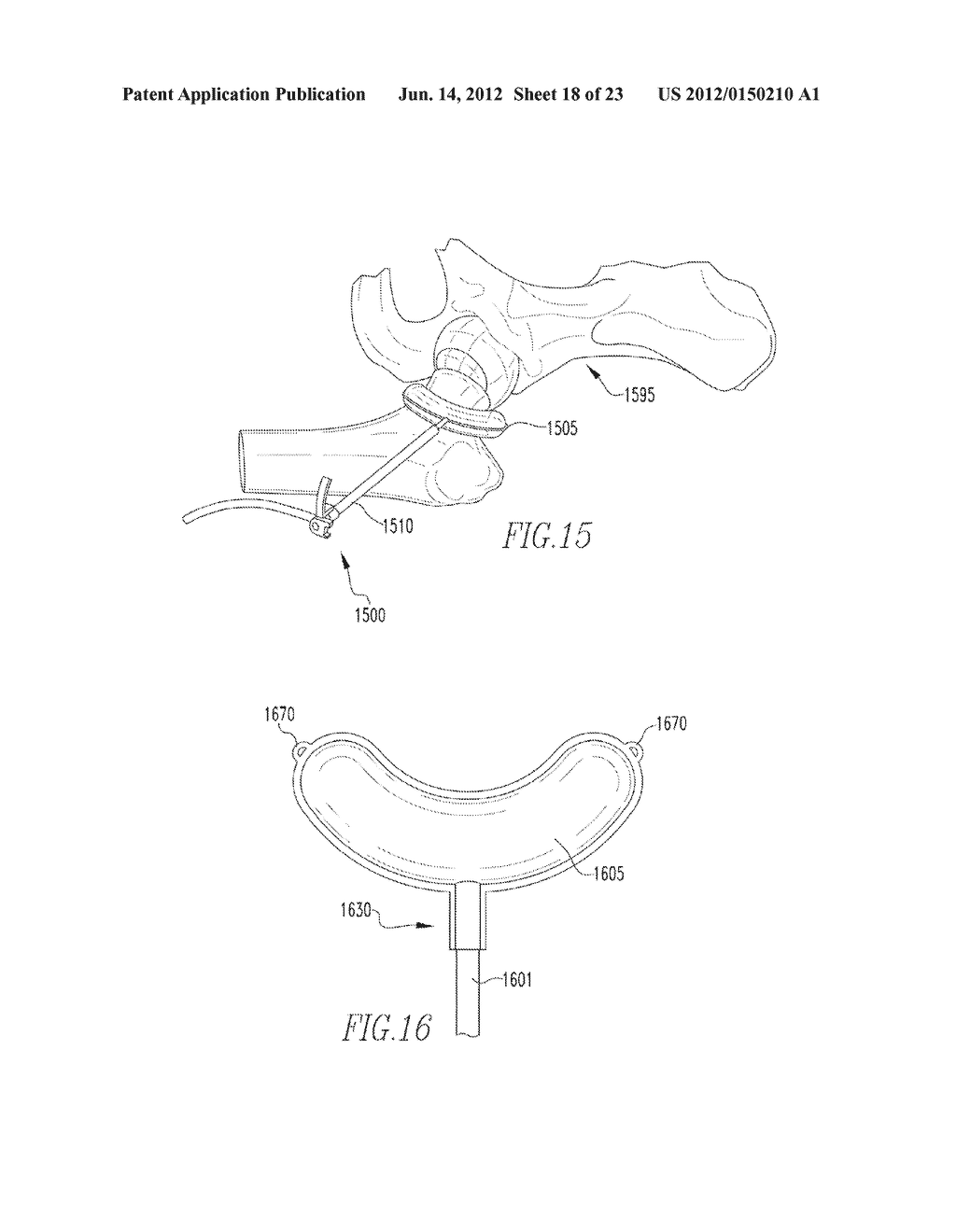 INFLATABLE, STEERABLE BALLOON FOR ELEVATION OF TISSUE WITHIN A BODY - diagram, schematic, and image 19