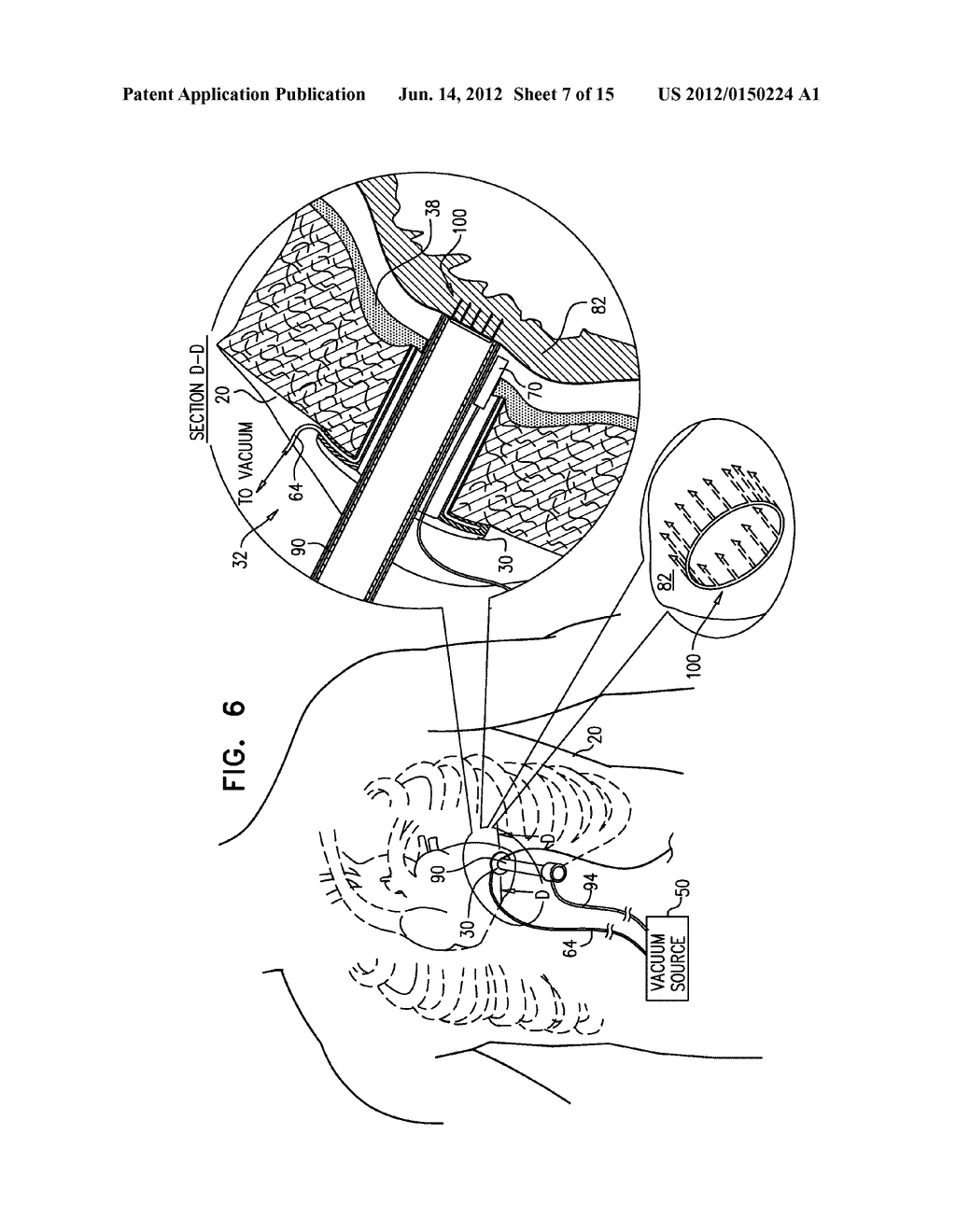 SURGICAL TECHNIQUES AND CLOSURE DEVICES FOR DIRECT CARDIAC CATHETERIZATION - diagram, schematic, and image 08