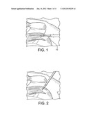 FENESTRATED SWIVEL ANCHOR FOR KNOTLESS FIXATION OF TISSUE diagram and image