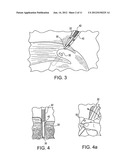 FENESTRATED SWIVEL ANCHOR FOR KNOTLESS FIXATION OF TISSUE diagram and image