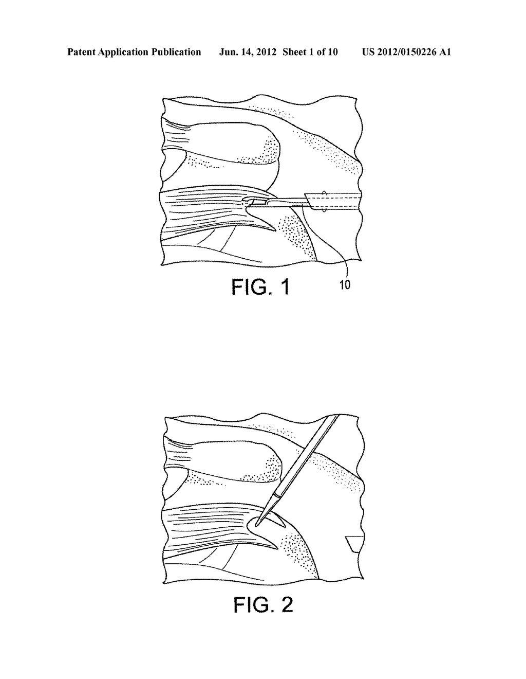 SELF-PUNCHING SWIVEL ANCHOR AND METHOD FOR KNOTLESS FIXATION OF TISSUE - diagram, schematic, and image 02