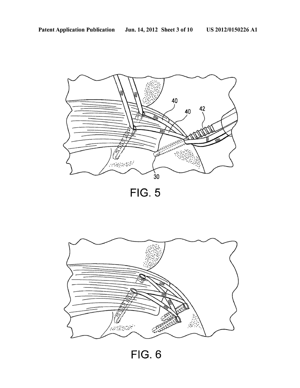 SELF-PUNCHING SWIVEL ANCHOR AND METHOD FOR KNOTLESS FIXATION OF TISSUE - diagram, schematic, and image 04