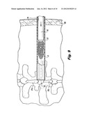 INTERSPINOUS PROCESS IMPLANTS HAVING DEPLOYABLE ENGAGEMENT ARMS diagram and image