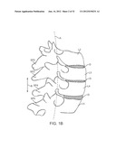 SACRAL TETHER ANCHOR AND METHODS OF USE diagram and image