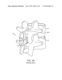 SACRAL TETHER ANCHOR AND METHODS OF USE diagram and image