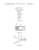 SACRAL TETHER ANCHOR AND METHODS OF USE diagram and image