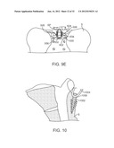 SACRAL TETHER ANCHOR AND METHODS OF USE diagram and image