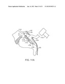 SACRAL TETHER ANCHOR AND METHODS OF USE diagram and image