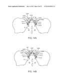 SACRAL TETHER ANCHOR AND METHODS OF USE diagram and image