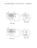 SACRAL TETHER ANCHOR AND METHODS OF USE diagram and image