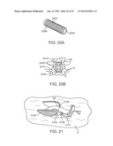 SACRAL TETHER ANCHOR AND METHODS OF USE diagram and image