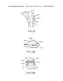 SACRAL TETHER ANCHOR AND METHODS OF USE diagram and image