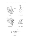 SACRAL TETHER ANCHOR AND METHODS OF USE diagram and image