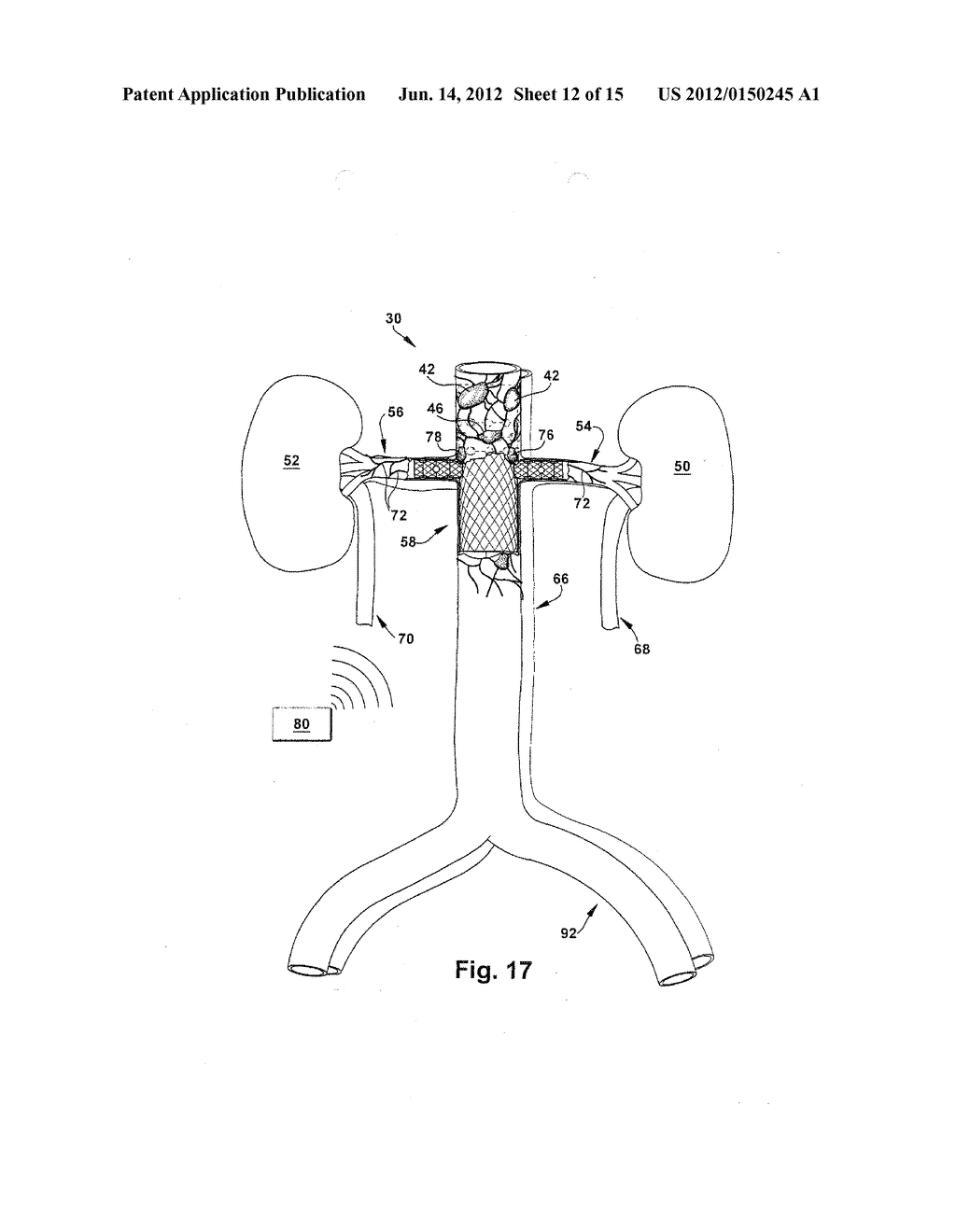 METHOD AND APPARATUS FOR RENAL NEUROMODULATION - diagram, schematic, and image 13