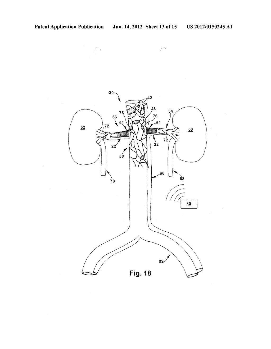 METHOD AND APPARATUS FOR RENAL NEUROMODULATION - diagram, schematic, and image 14