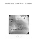 Admittance measurement for tuning bi-ventricular pacemakers diagram and image