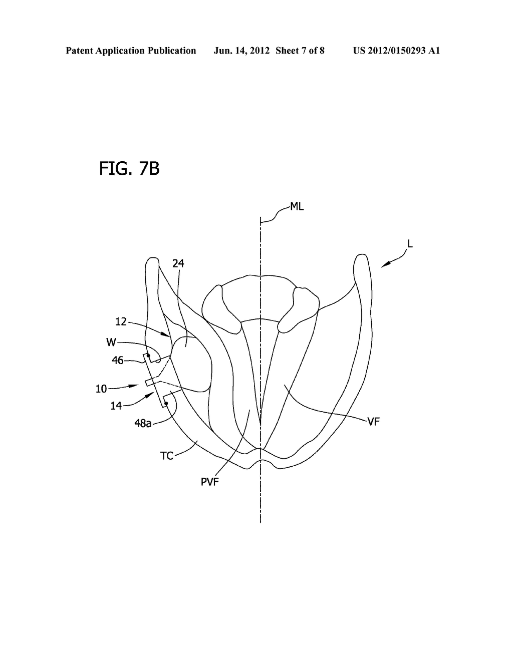 LARYNGEAL IMPLANT FOR TREATING GLOTTIC INSUFFICIENCY - diagram, schematic, and image 08