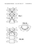 SPINE SUPPORT IMPLANT INCLUDING INTER VERTEBRAL INSERTABLE FLUID     BALLASTABLE INSERT AND INTER-VERTEBRAL WEB RETAINING HARNESSES diagram and image