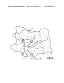 SPINE SUPPORT IMPLANT INCLUDING INTER VERTEBRAL INSERTABLE FLUID     BALLASTABLE INSERT AND INTER-VERTEBRAL WEB RETAINING HARNESSES diagram and image