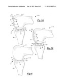 Pyrocarbon Orthopedic Implant diagram and image