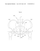 HIP JOINT DEVICE AND METHOD diagram and image