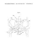 HIP JOINT DEVICE AND METHOD diagram and image