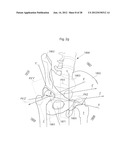 HIP JOINT DEVICE AND METHOD diagram and image