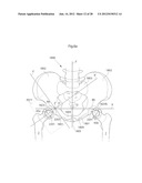 HIP JOINT DEVICE AND METHOD diagram and image