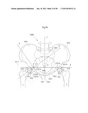 HIP JOINT DEVICE AND METHOD diagram and image