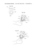 HIP JOINT DEVICE AND METHOD diagram and image