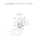 HIP JOINT DEVICE AND METHOD diagram and image