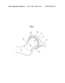 MEDICAL DEVICE AND METHOD FOR TREATMENT OF HIP JOINT diagram and image