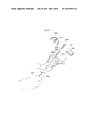 MEDICAL DEVICE AND METHOD FOR TREATMENT OF HIP JOINT diagram and image