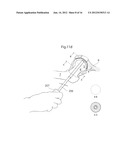 MEDICAL DEVICE AND METHOD FOR TREATMENT OF HIP JOINT diagram and image