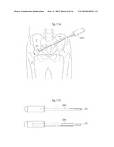 MEDICAL DEVICE AND METHOD FOR TREATMENT OF HIP JOINT diagram and image