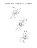 MEDICAL DEVICE AND METHOD FOR TREATMENT OF HIP JOINT diagram and image