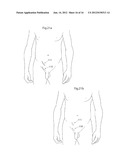 MEDICAL DEVICE AND METHOD FOR TREATMENT OF HIP JOINT diagram and image