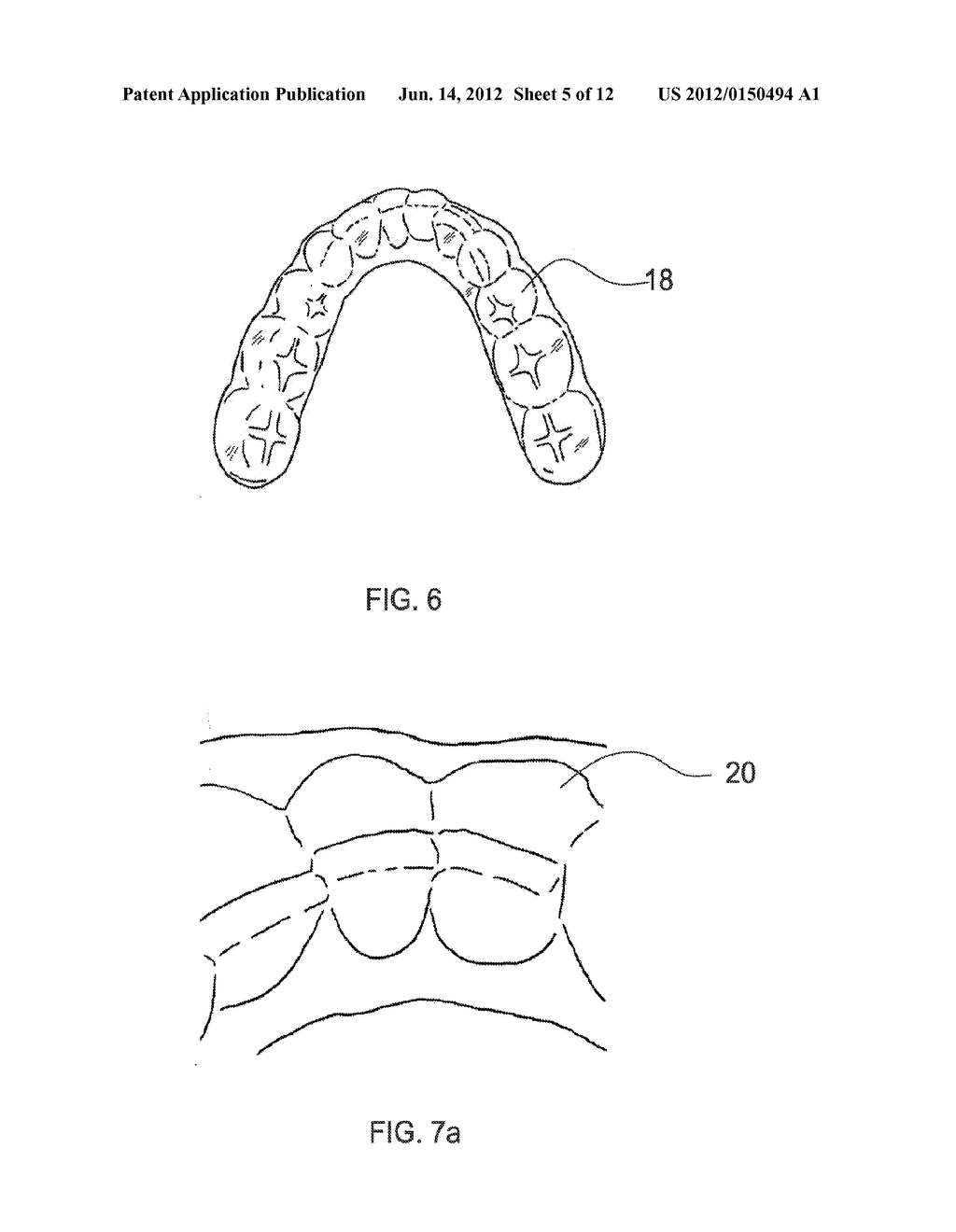 ORTHODONTIC ALIGNER FABRICATION BY OVERLAY METHOD - diagram, schematic, and image 06