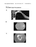 VACCINE THERAPY FOR CHOROIDAL NEOVASCULARIZATION diagram and image