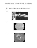 VACCINE THERAPY FOR CHOROIDAL NEOVASCULARIZATION diagram and image