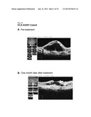 VACCINE THERAPY FOR CHOROIDAL NEOVASCULARIZATION diagram and image
