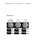 VACCINE THERAPY FOR CHOROIDAL NEOVASCULARIZATION diagram and image