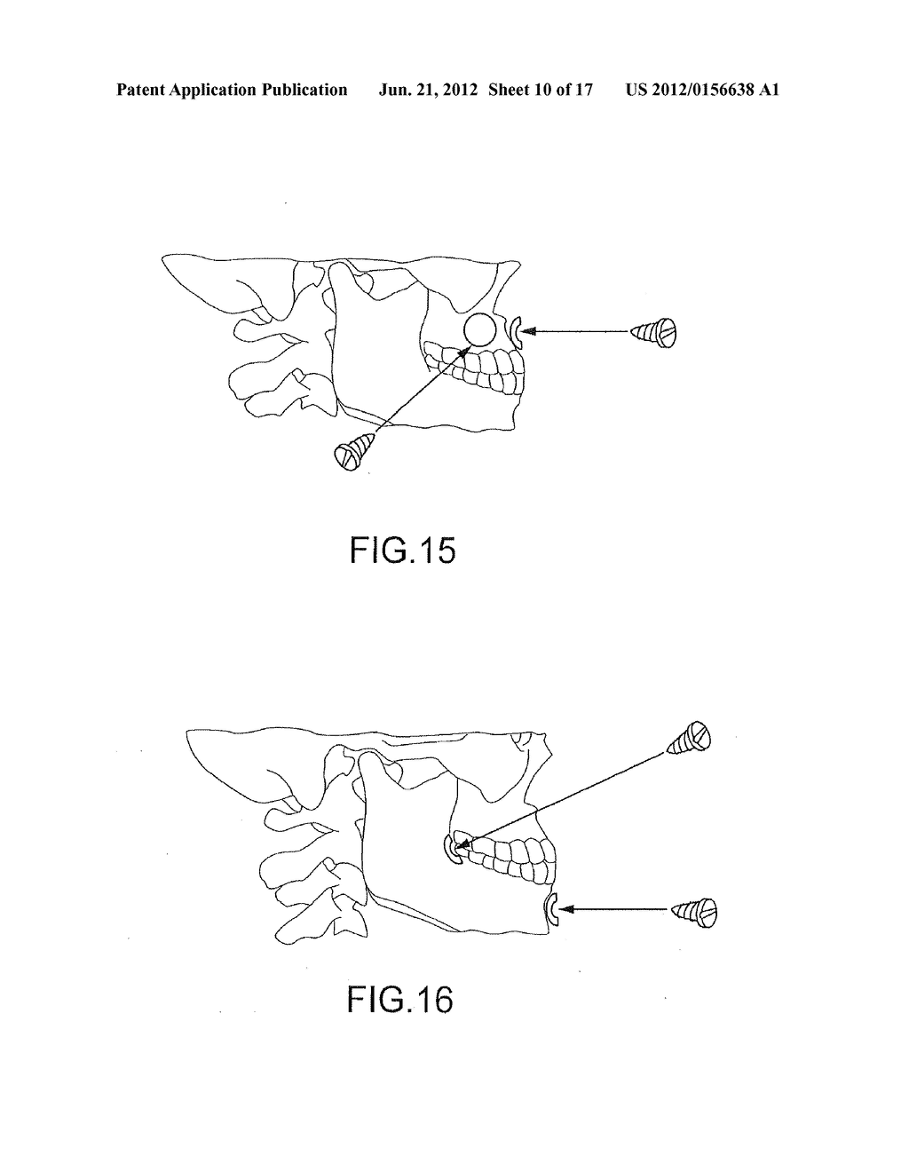 ASSISTED DENTAL IMPLANT TREATMENT - diagram, schematic, and image 11