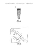 SYSTEM AND METHOD FOR PREVENTION AND TREATMENT OF PERI-IMPLANT INFECTION diagram and image