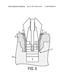 SYSTEM AND METHOD FOR PREVENTION AND TREATMENT OF PERI-IMPLANT INFECTION diagram and image