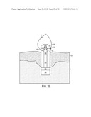 SYSTEM AND METHOD FOR PREVENTION AND TREATMENT OF PERI-IMPLANT INFECTION diagram and image