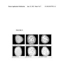 TREATMENT OF MACULAR DEGENERATION diagram and image