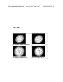 TREATMENT OF MACULAR DEGENERATION diagram and image